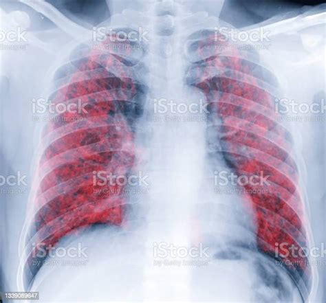 인간 가슴 또는 폐의 흉부 엑스레이는 코로나 바이러스 2019를 검출한 후에 폐를 보여줍니다 폐암에 대한 스톡 사진 및 기타