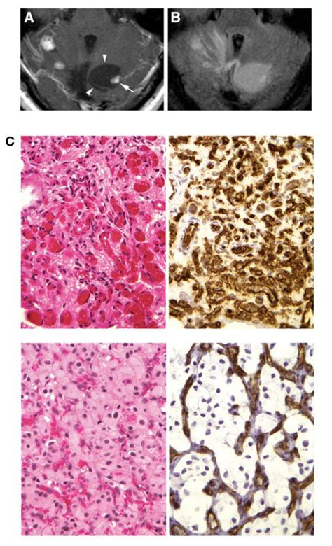 Radiological And Histologic Presentation Of Hemangioblastomas A