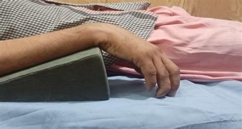 Right wrist and hand of the patient before treatment depicting wrist ...