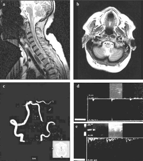 A B Mri Ge Philips 3 T Sagittal A And Axial B T2 Weighted Images