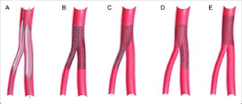 Various Endovascular Techniques For Femoral Bifurcation Lesions A