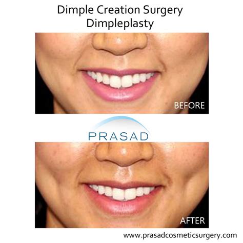 Dimple Surgery Dimple Creation Learn More New York