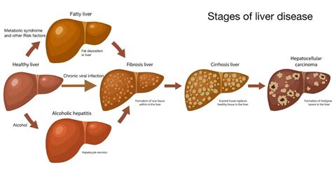 Cirrhosis Of Liver By Dr Vishal Khurana Senior Gastroenterologist Faridabad