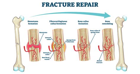 Internal Fixation Vs External Fixation Orthofix