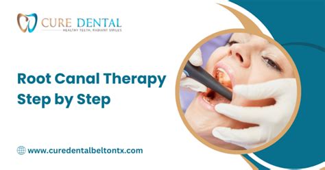 Root Canal Therapy Step By Step Cure Dental