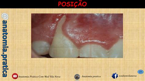 Estudos das doenças periodontais Gengivite Odontologia Anatomia