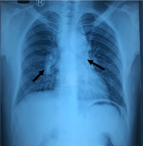 Chest Radiograph Showing Bilateral Hilar Adenopathy Right More Than Download Scientific