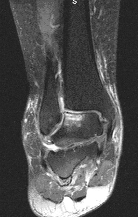 Osteonecrosis Of The Talus After Talonavicular Arthrodesis A Case