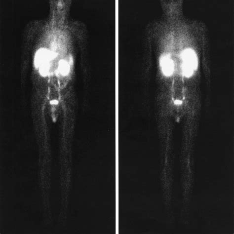 Whole Body Mtechnetium Annexin V Image Anterior A And Posterior