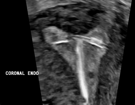 Accurate Detection Of Iud Placement Using 3d Ultrasound Sononotes