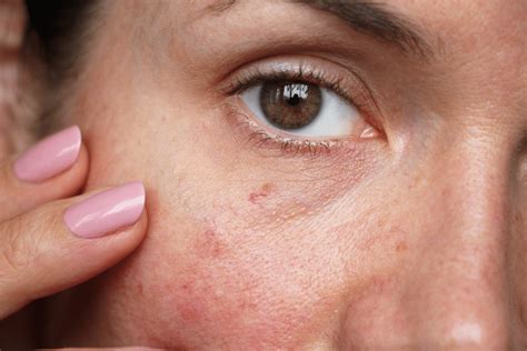 What Causes Spider Veins On Face How To Treat Them