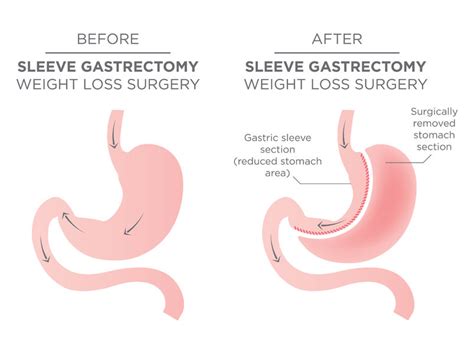 Roux En Y Gastric Bypass Before After