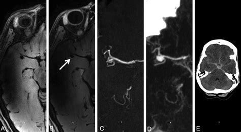 Gadolinium Enhancement Of The Aneurysm Wall In Unruptured Intracranial