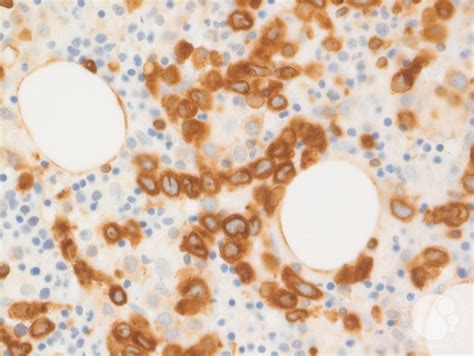 Intravascular Dlbcl Bcl2 Ihc