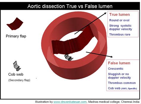 Aortic Septum Drsvenkatesan Md