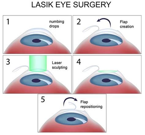 LASIK eye surgery for astigmatism | What you need to know