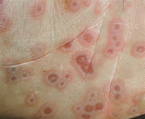 Erythema Multiforme — Advanced Dermatology