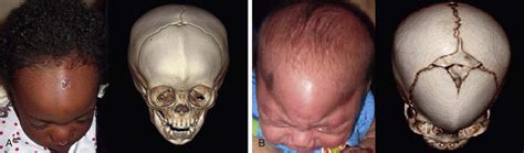 Congenital Craniofacial Anomalies And Their Management