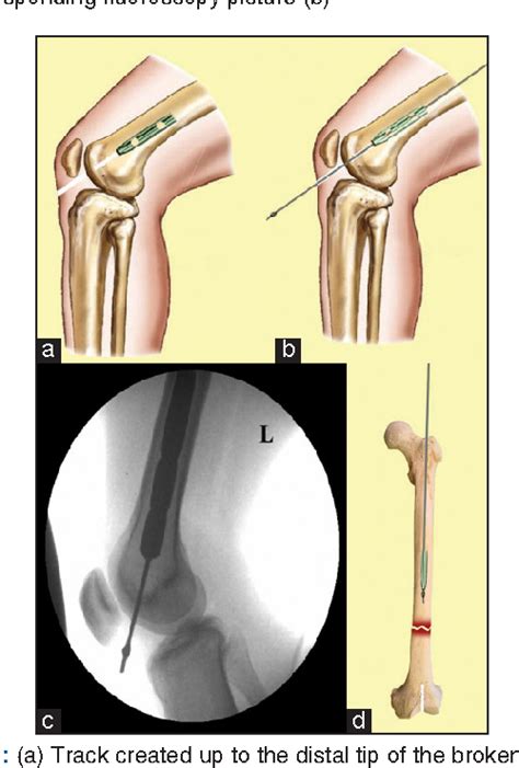 Figure From Closed Retrograde Retrieval Of The Distal Broken Segment