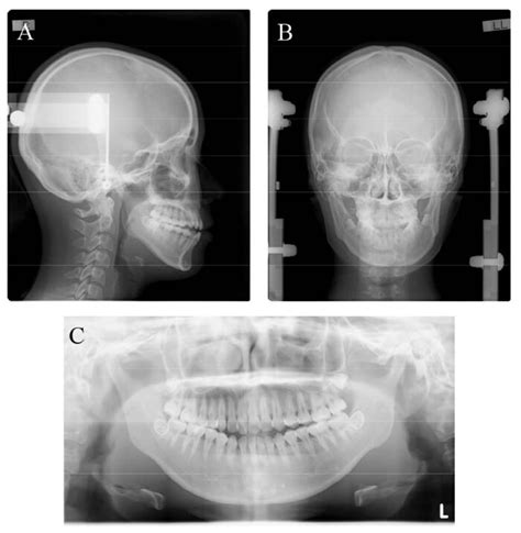 A Pretreatment Lateral Cephalogram B Posteroanterior Cephalogram