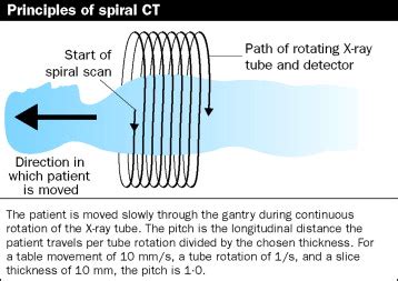 Spiral Ct Scan