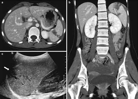 Liver Biliary Tract Pancreas And Spleen Radiology Key