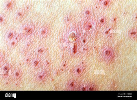 Tras El Tratamiento De La Piel Con El Herpes Zoster Culebrilla