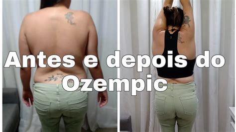 Ozempic Emagrecimento Como Aplicar Ozempic Ozempic Antes Depois Hot