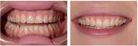 Фото зубів до і після встановлення елайнерів | Soloaligners