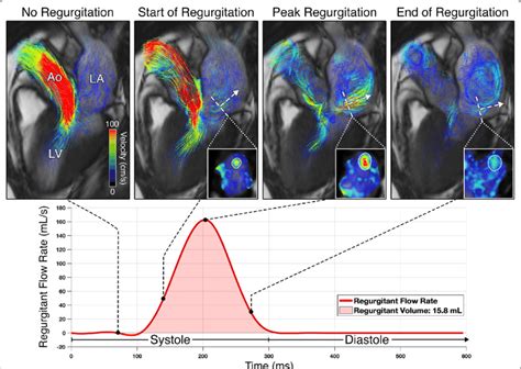 D Flow Cmr Jet Tracking Analysis For Direct Mr Quantification La