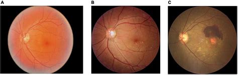 Frontiers Classification Of Dry And Wet Macular Degeneration Based On