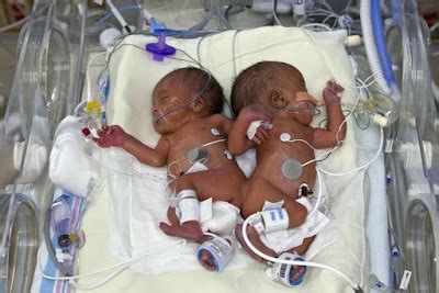 Celebrities Naked Conjoined Twins Separated Twins Jacob And Joshua