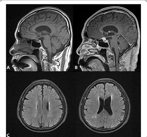 Sagittal T1 Weighted A Pre Contrast And B Post Contrast MRI Showing