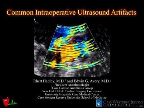 Common Intraoperative Ultrasound Artifacts