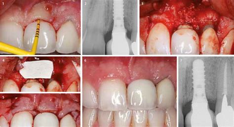 Peri Implantitis And Management Dgoi