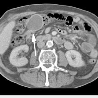 Axial Ct Showing Colocolic Intussusception And An Ovoid Hypodense Mass