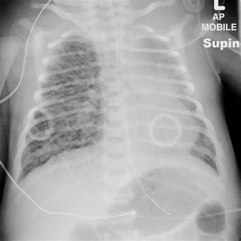 Pulmonary interstitial emphysema causes, symptoms, diagnosis, treatment ...