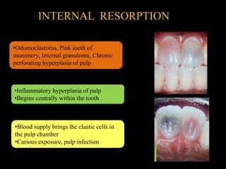 Resorption Of Teeth Ppt