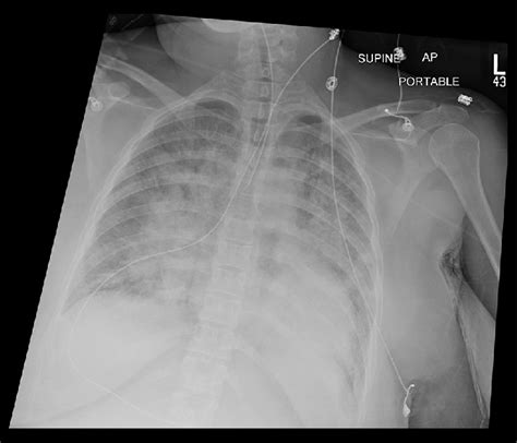 Chest X Ray Of The Patient Showing Bilateral Fluffy Infiltrates