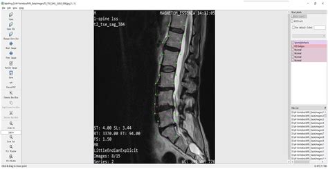 Lumbar Spine Mri Labeled