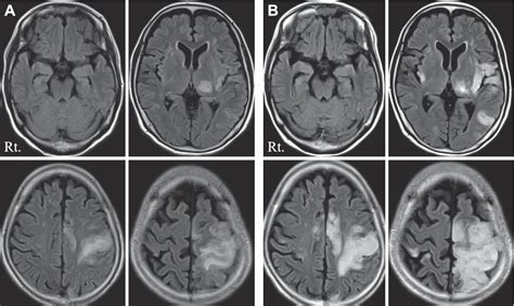 Figure 1 From Herpes Simplex Encephalitis Presenting As Stroke Like