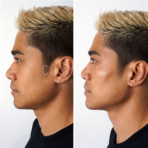 Cheek Contouring Fillers Cosmetic Connection