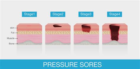 Ulkus Dekubitus Penyebab Gejala Dan Cara Penanganan Galeri Medika