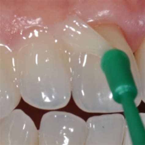 Fluoride Varnish Application - Education For Dental