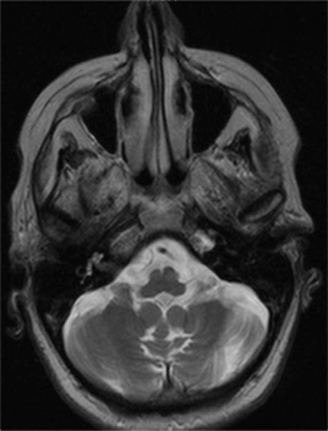 Axial T2 Weighted Magnetic Resonance Image Of The Patient Showing