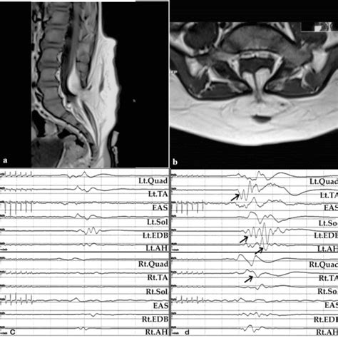 Sagittal (a) and axial (b) T1W MR images showing a lipomyelomeningocele ...