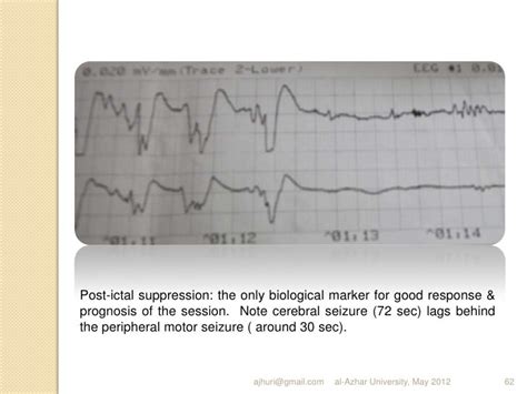 Study sheds light on postictal generalised EEG suppression - EpilepsyU