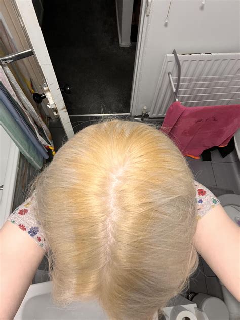 Update On Bleaching My Roots R Fancyfollicles