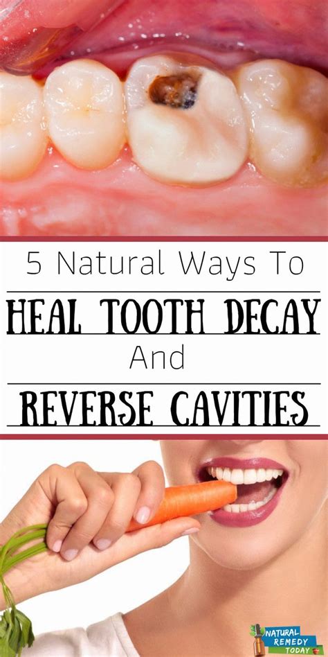 Reverse Tooth Decay Tooth Decay Tooth Decay Remedies Tooth