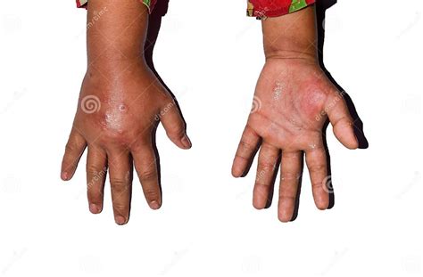 Edema With Scabies Swollen Hands And Arms Of Asian Child Stock Image